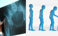EPO can potentially help alleviate the bone pain of osteoporosis (Image via Empower Healthcare)